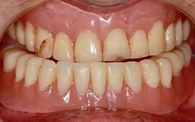 Bridges complet sur 4 implants dentaires